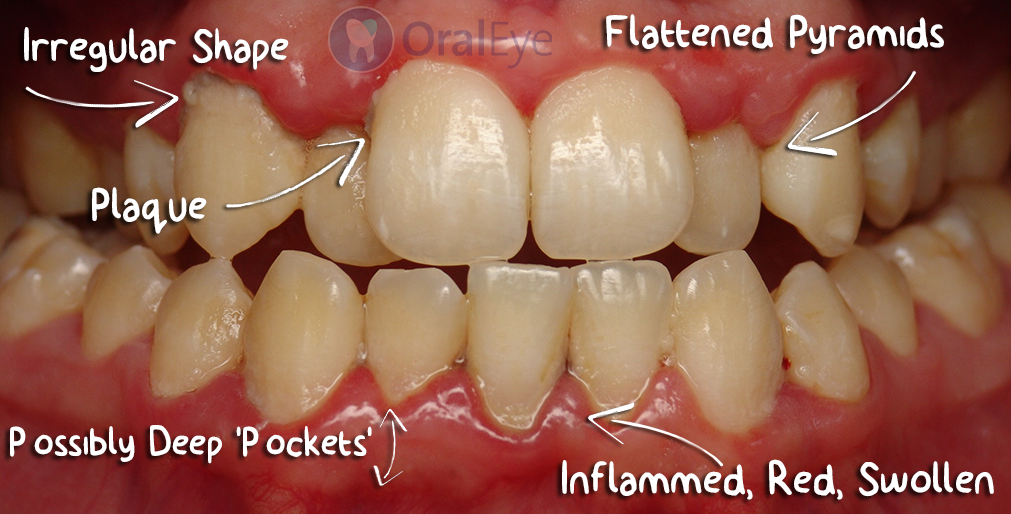 poor dental health