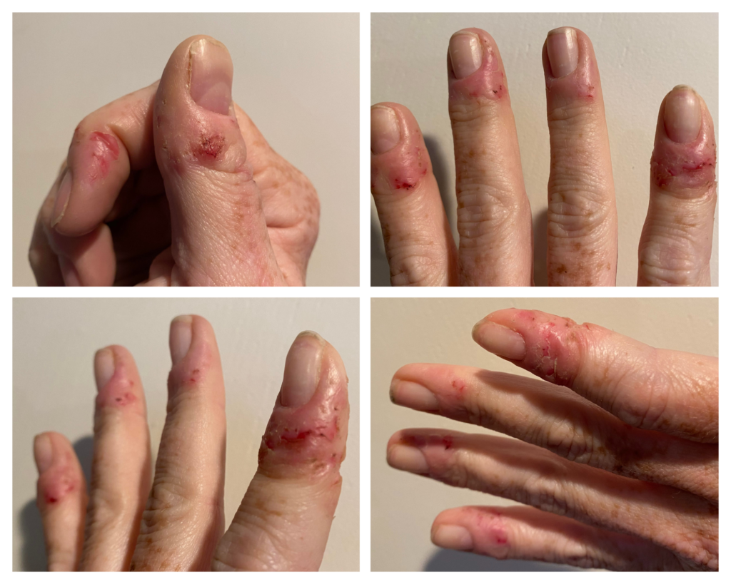 Dermatophagia in adult woman 